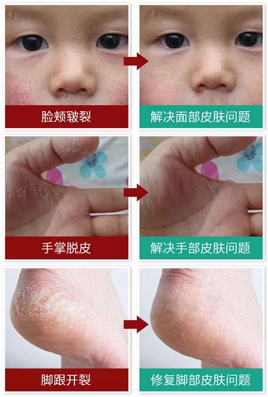 凤凰网梧桐汇商城|皮肤干痒、开裂、脱皮?用它抹一抹,立马见效