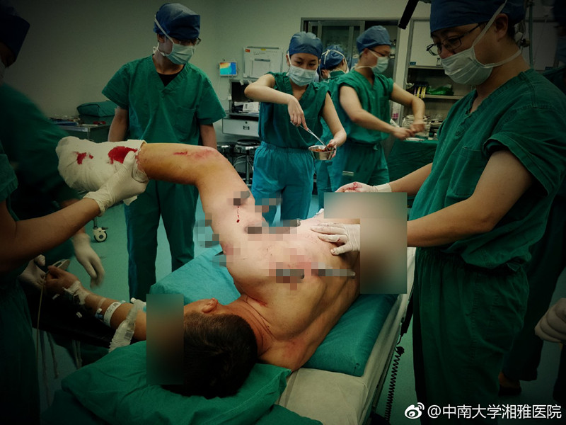男子被10根30厘米长钢钉刺穿身体，医生紧急施救成功