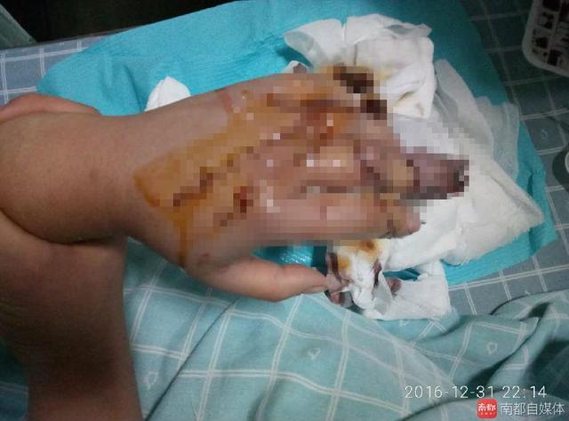 深圳一女子电梯中突遭持刀抢劫，两手指被砍断
