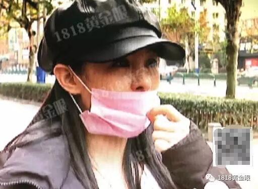 姑娘为整容打掉孩子 鼻孔被整成“猪八戒”(组图)