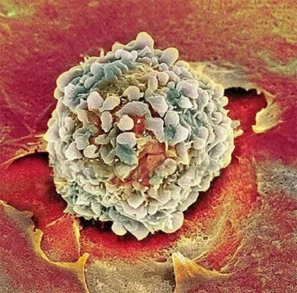 看显微镜下的各类癌细胞:画风完全不一样