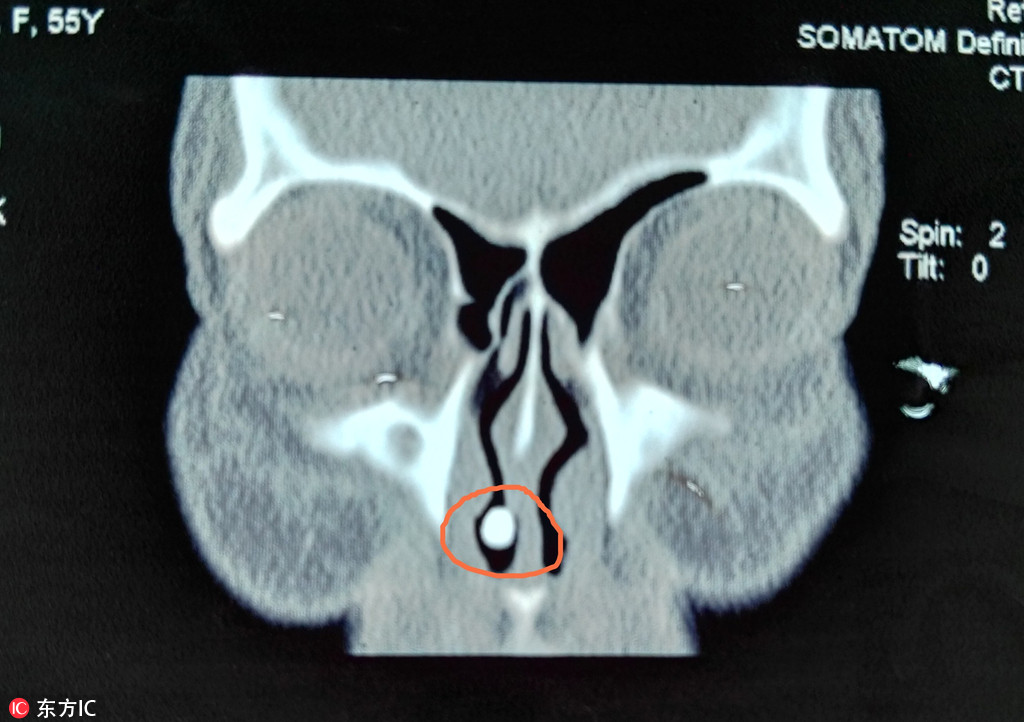 湖南女子鼻塞数十年 竟然是鼻子里长了一颗牙
