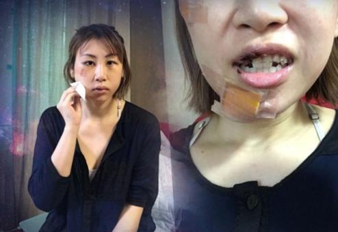 女歌手韩国旅游跌倒撞钢椅毁容 牙齿断裂嘴缝23针