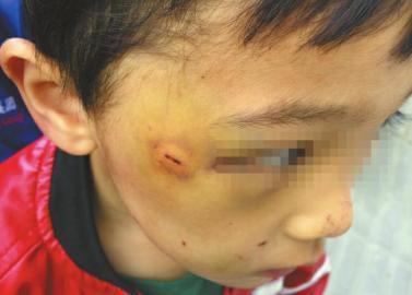 孩子眼角附近的伤口肿了起来。