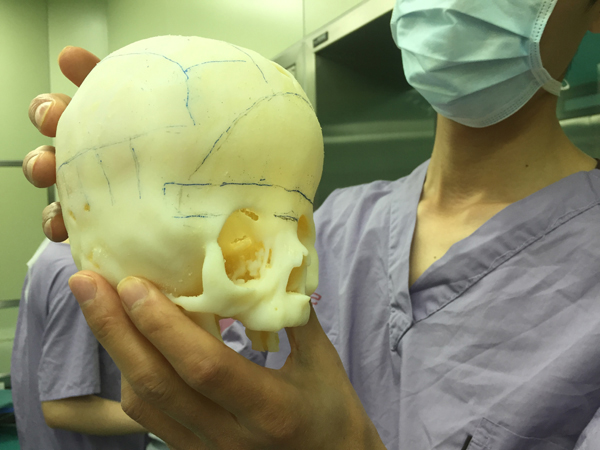 上海医生为8个月大狭颅症患儿重拼颅骨,小外