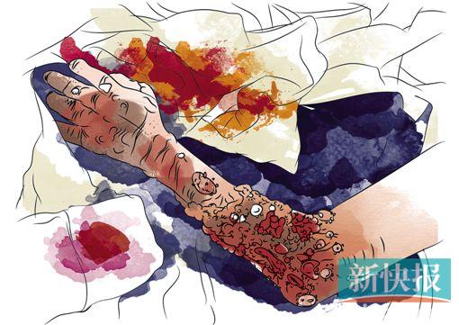 ●如果只是局部伤口肿胀,还没超过一个关节肿胀范围,也没有全身中毒症状为轻症;如果伤口肿胀超过两个大关节,并继发全身中毒表现的为重症。