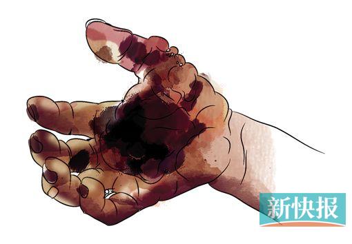 ●像这样的伤口肿胀症状,要把伤口划开放脓,再做进一步处理。