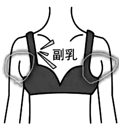 【提醒 副乳种类不同,危害不同