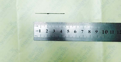 手术中取出的缝衣针。