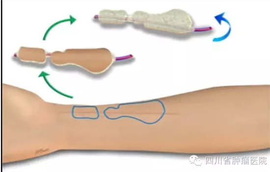 前臂皮瓣示意图2