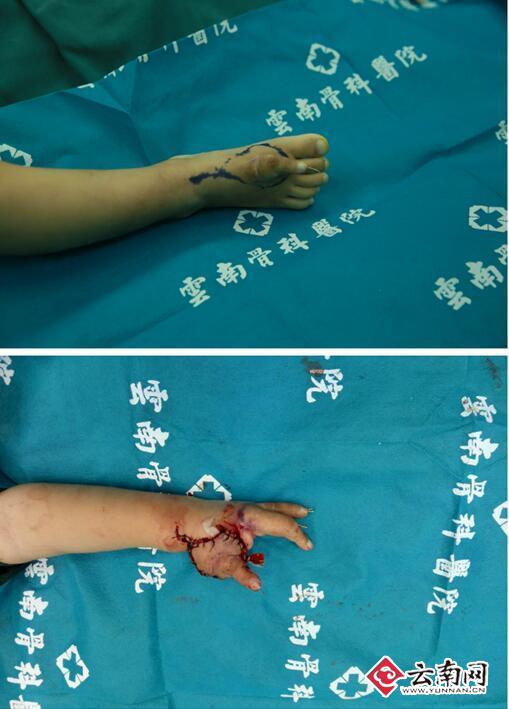 配图：手术前食指寄养在小铭的脚背上，手术后被移植回左手上，再造成拇指。