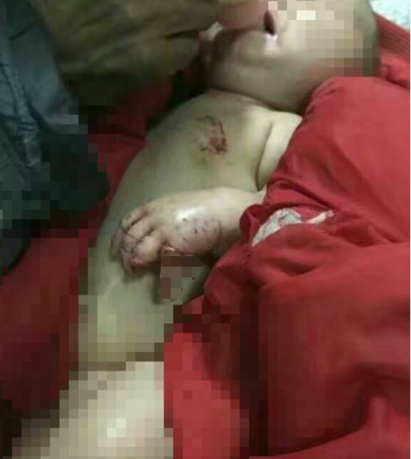 婴儿被咬伤状况。图片均来自衡阳新闻网