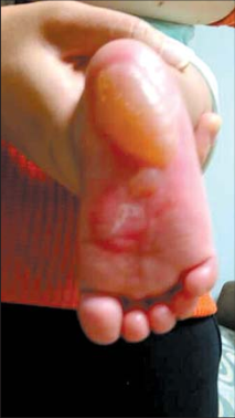 六月大婴儿做艾灸脚底被三度烫伤