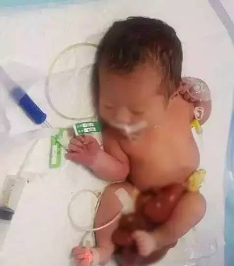 揪心！刚出生女婴被弃医院，消化器官露在肚子外