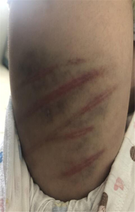 扬州一10岁女童疑遭家暴全身有数十道血痕