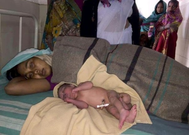 罕见新生儿有四只腿和两性生殖器官