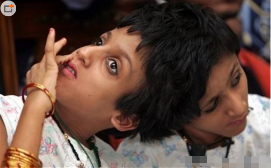 连体双胞胎的惊奇人生