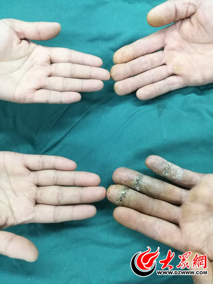 文莱务工致伤三根手指半月后中国医生再接成功