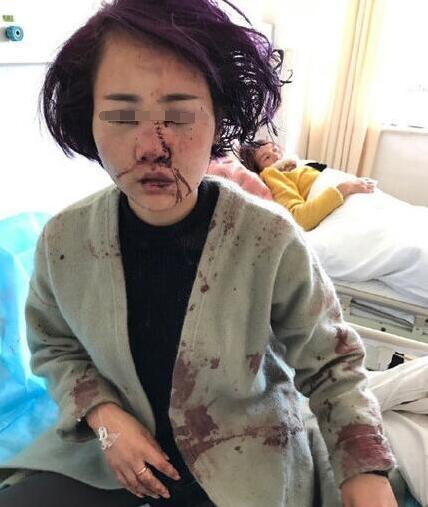 丽江遭暴打女子:无法接受毁容事实 已拟好遗书